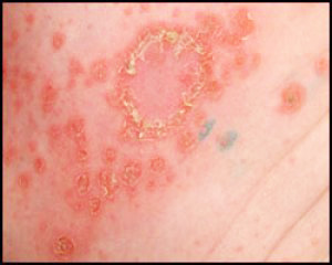  Воспаление лимфоузлов в паху у мужчин при инфекции кожи