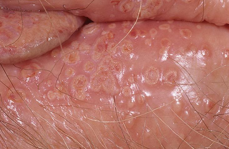 на коже паховой области и слизистых половых органов образуются мелкие пузырьки с прозрачным содержимым.