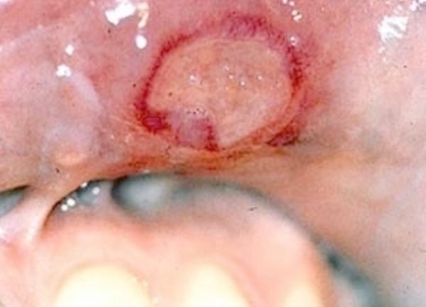 сифилитический первичный шанкр во рту 