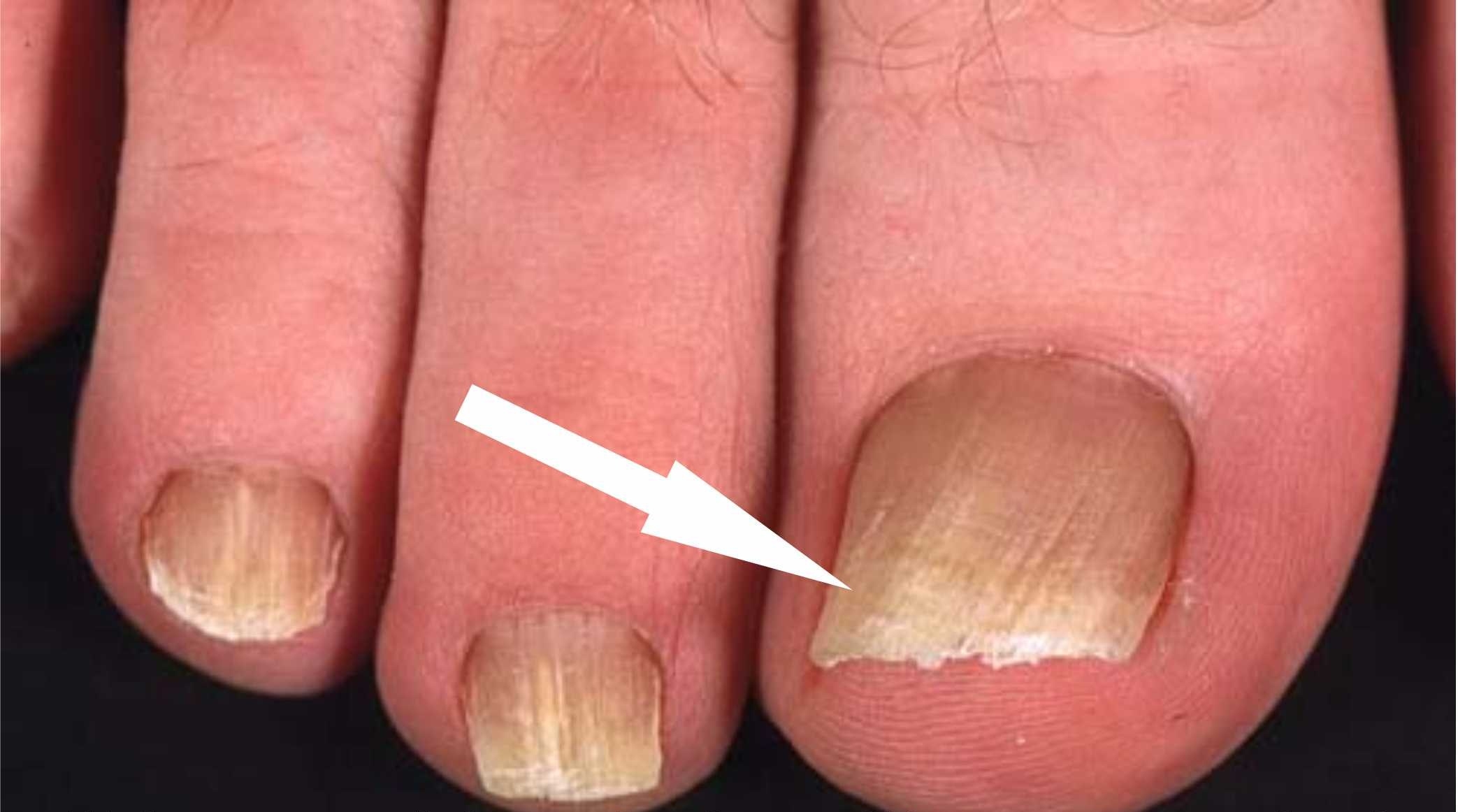 изменения цвета ногтя при нормотрофическом онихомикозе