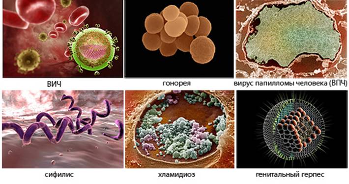 В норме в анализах не должны обнаруживаться патогенные микроорганизмы, являющиеся возбудителями венерических заболеваний.