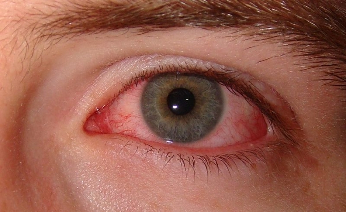  покраснение глаз при болезни рейтера