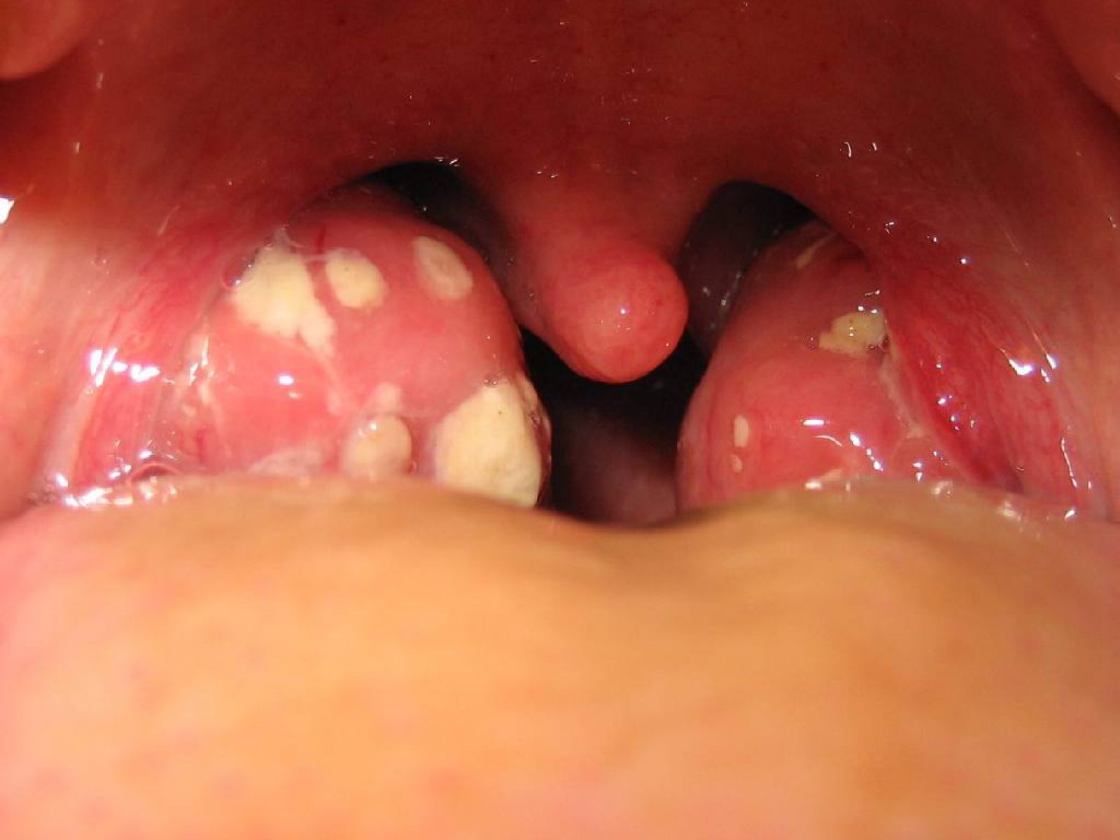   Заболевания горла после орального секса