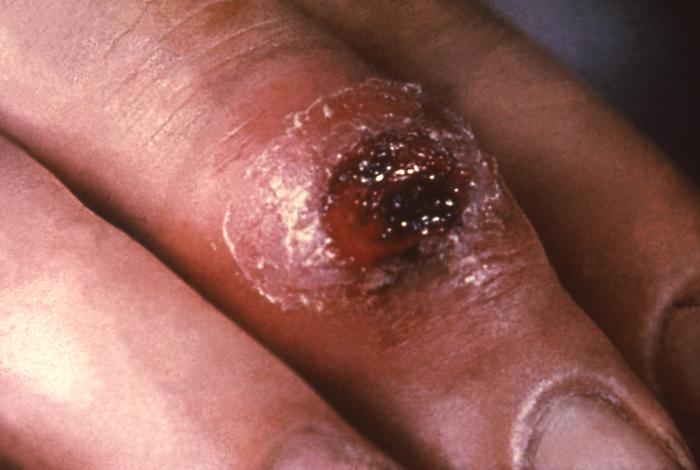 первичный шанкр сифилиса при бытовом заражении на пальце кисти