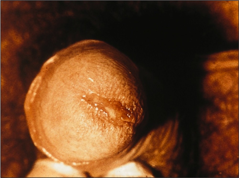  нормальные выделения из уретры у мужчин – секрет уретральных желез