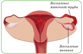 воспаление яичника и маточных труб при уреаплазмозе