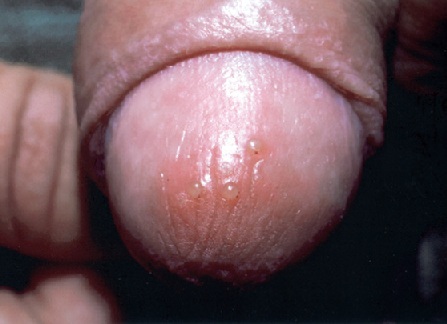 воспалительный процесс сопровождается появлением сыпи в виде пузырьков при генитальном герпесе