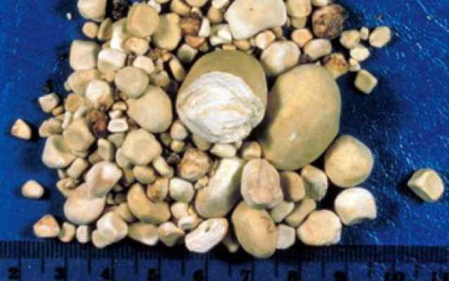 камни в почках при мочекаменной болезни