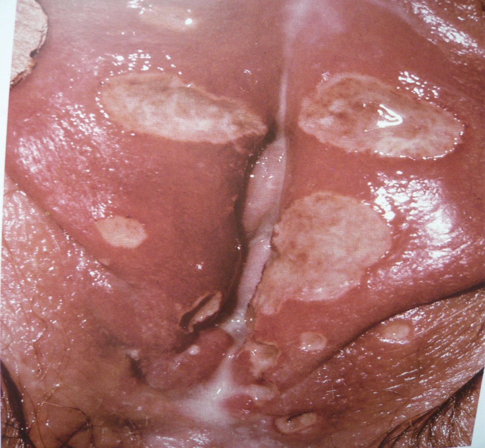  язвы в области половых губ при половых инфекциях