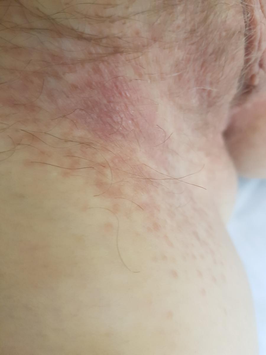 Бляшка при атопическом дерматите