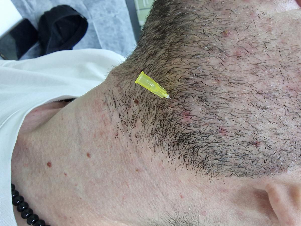 лимфотропная терапия лимфотропка