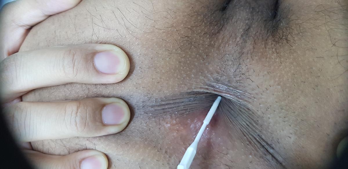 бактериальный посев посев на хламидии в лаборатории