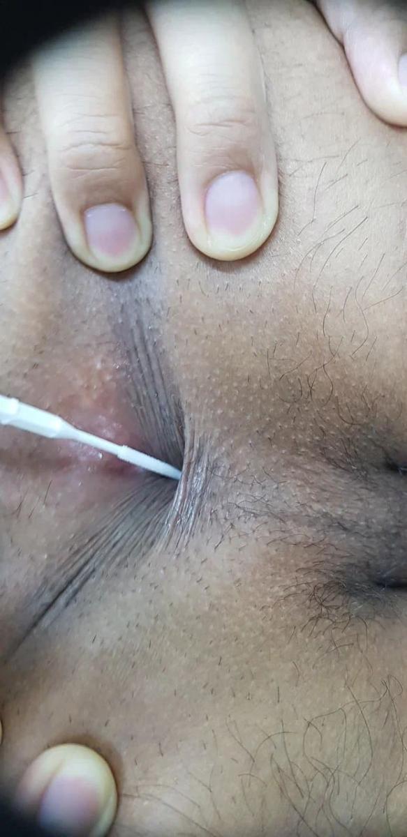 Заразились ИППП мазок