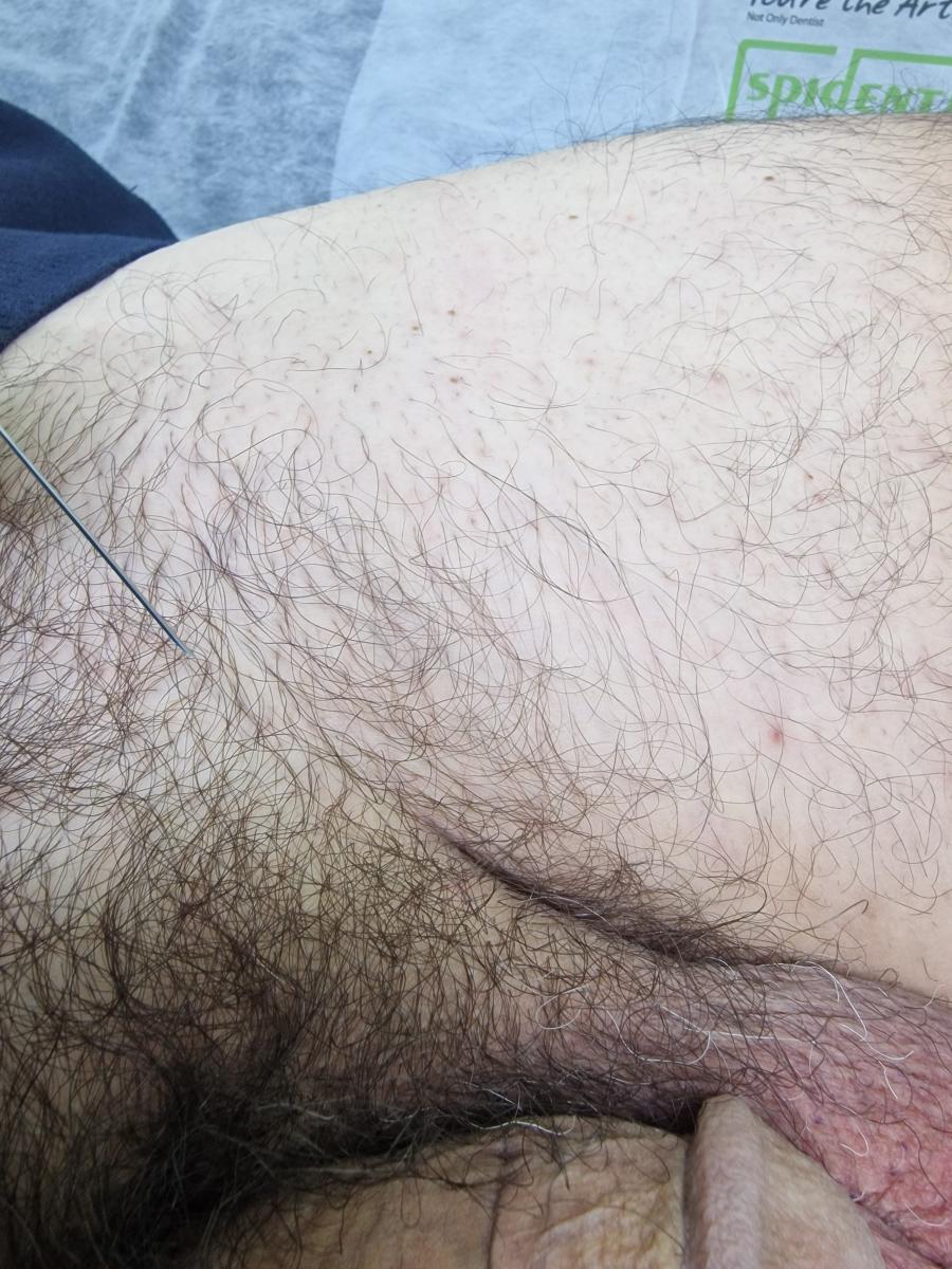 лимфотропка