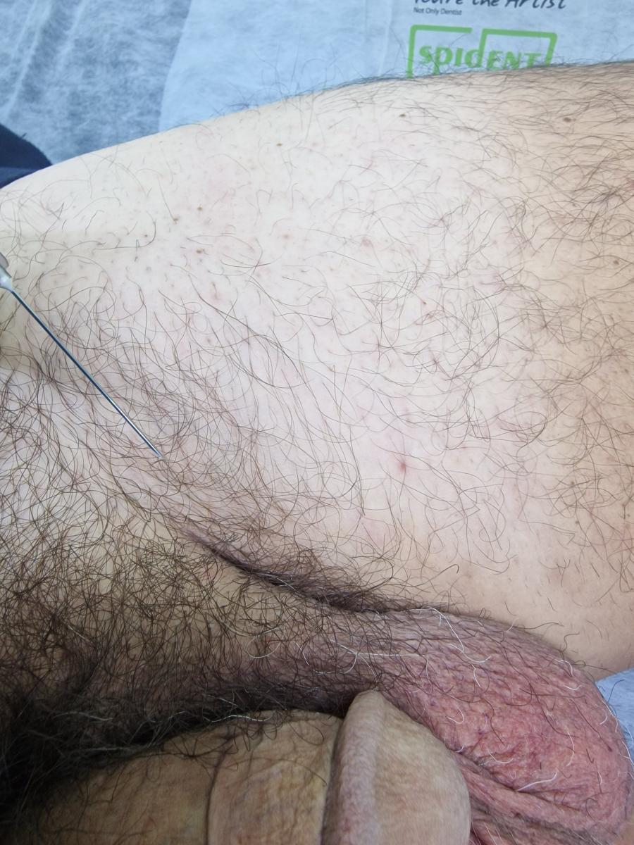 Лимфотропное введение препаратов