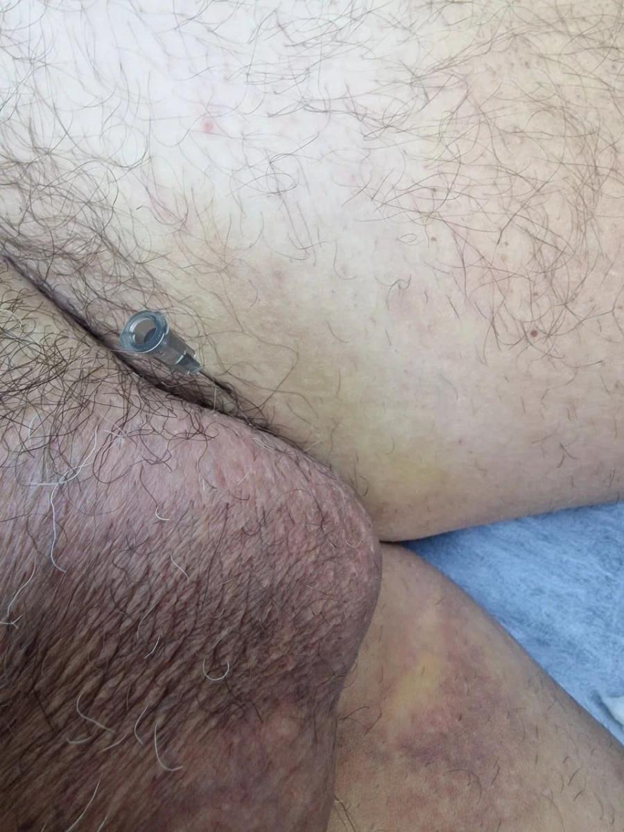 Лимфотропное введение