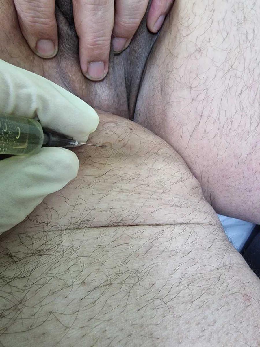 Лимфотропное введение Лимфотропное введение