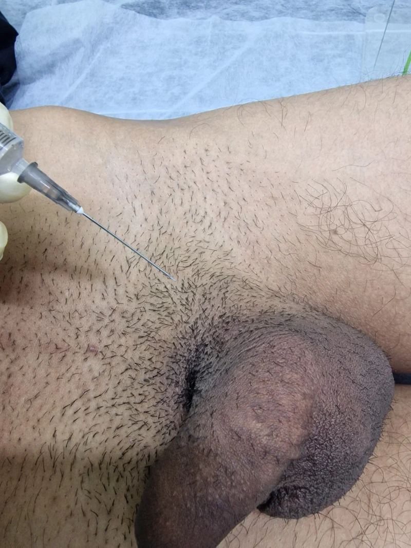 Лимфотропное введение