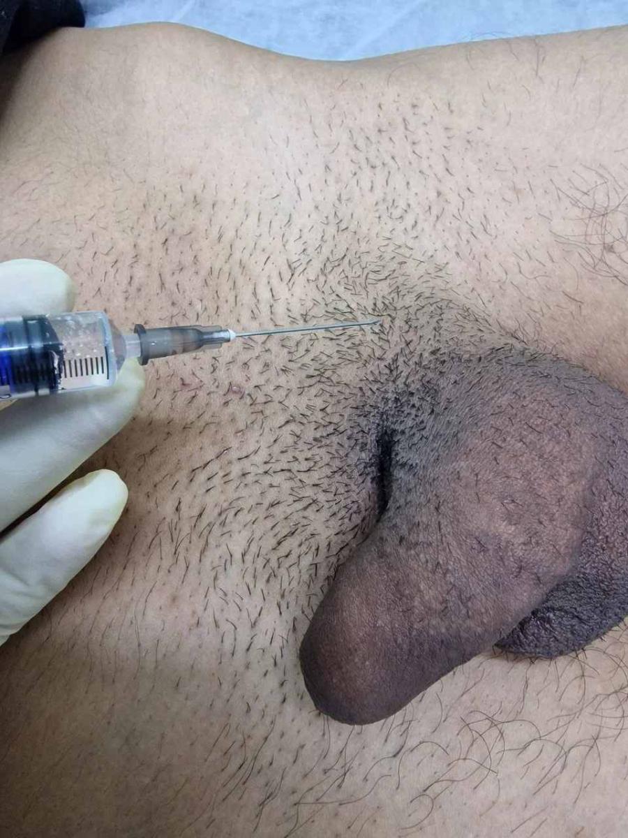 Лимфотропное введение