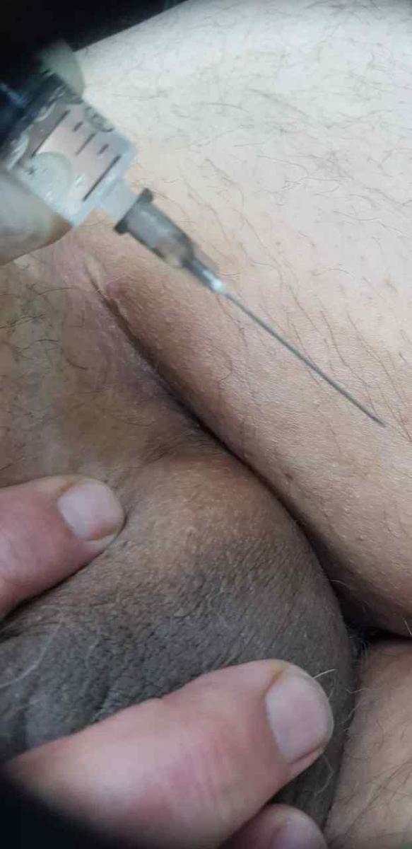 Лимфотропное введение