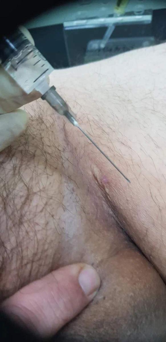 Лимфотропное введение Лимфотропное введение
