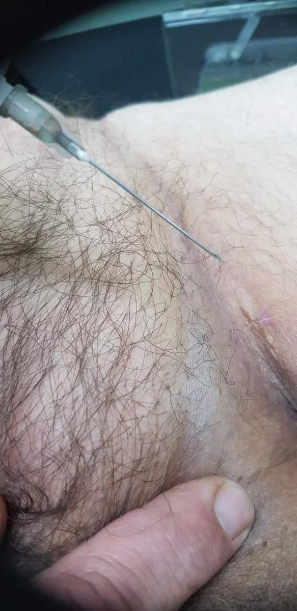 Лимфотропное введение Лимфотропное введение