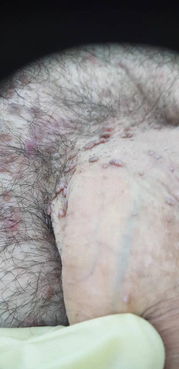 Множественные папилломы на головке полового члена
