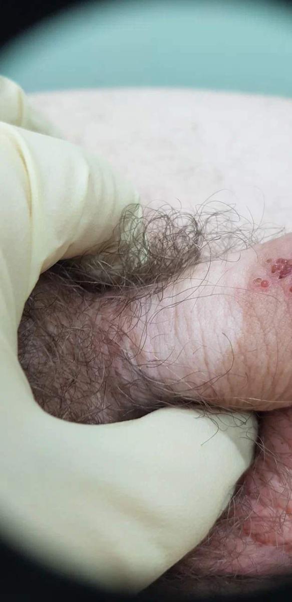 пятна на головке члена белые пятна при псориазе на коже полового члена