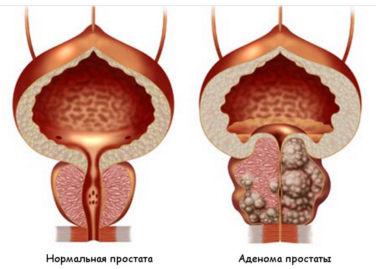 Здоровая простата и аденома