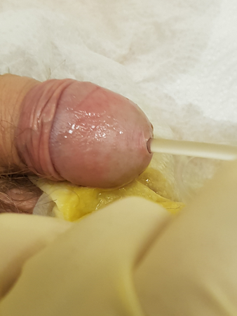 инстилляция сербра в уретру