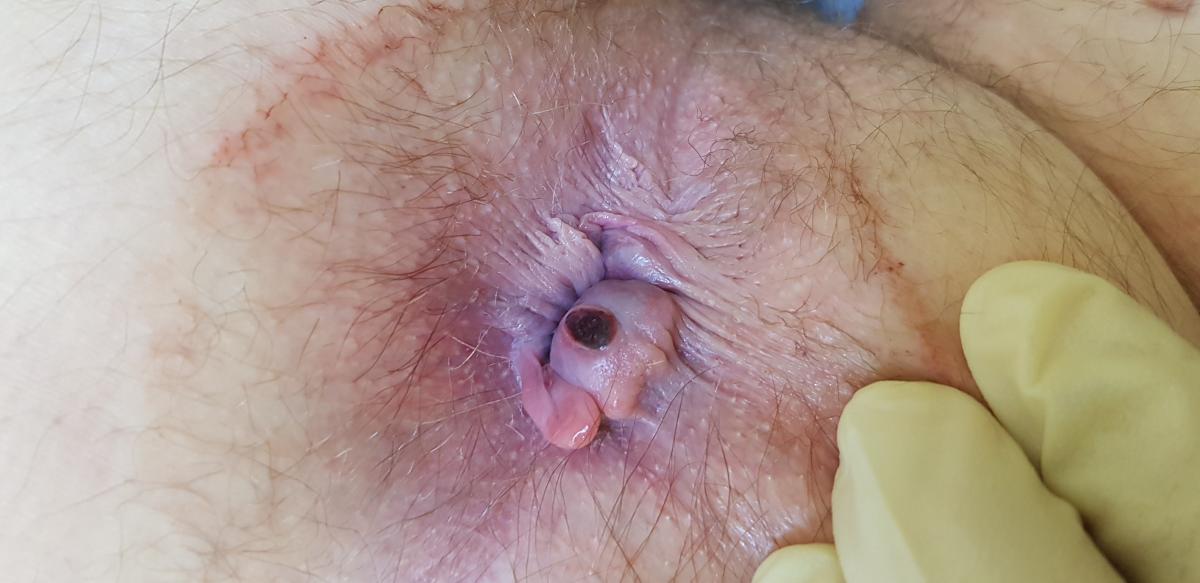 хламидийный проктит