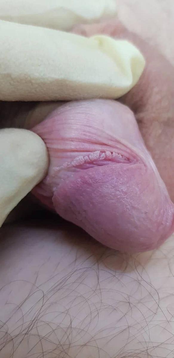 Язвы и эрозии 