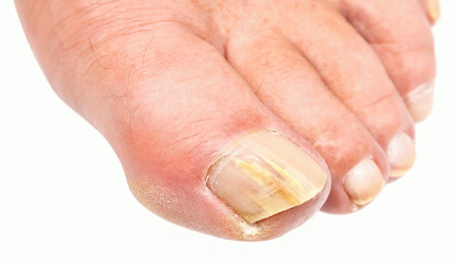 грибковые поражения ногтей стоп