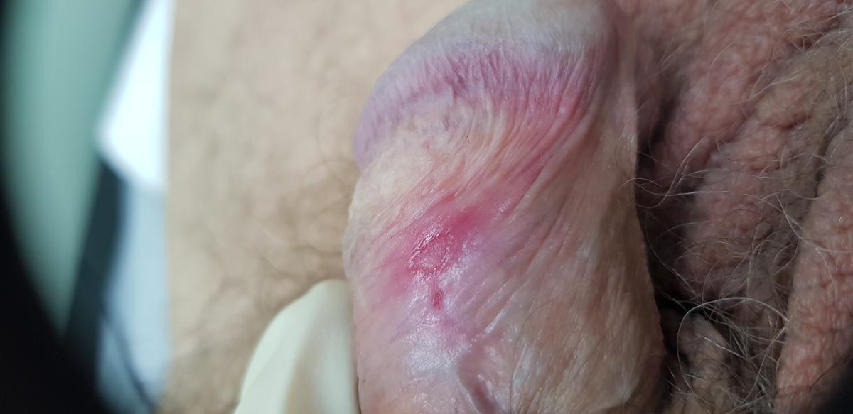 афты сифилис