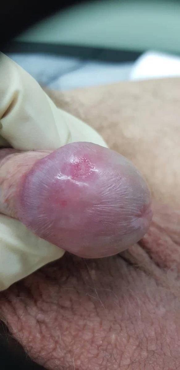 афты на головке и плоти