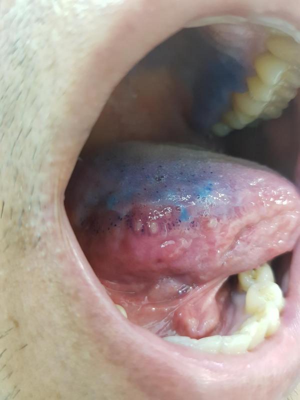  уреаплазмоз во рту