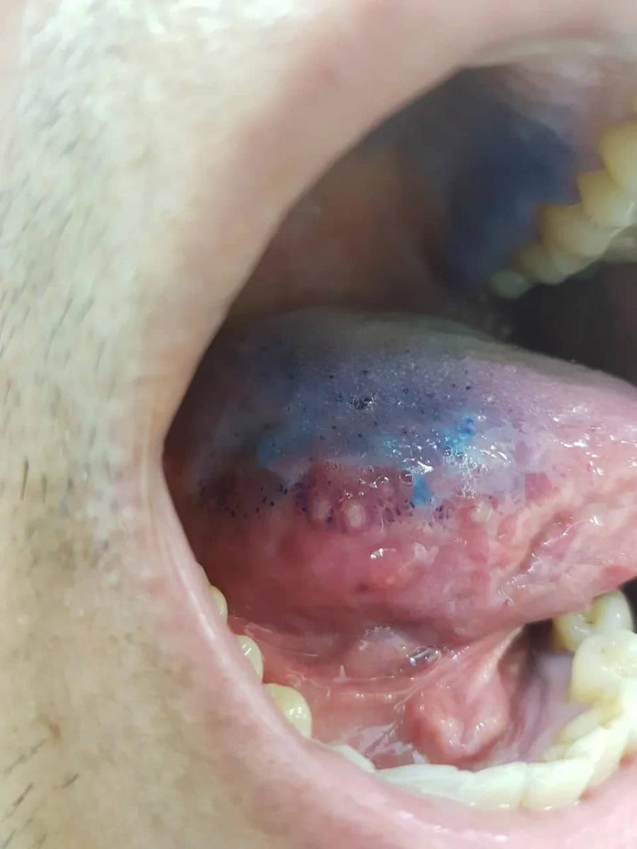 афты на языке афты на языке