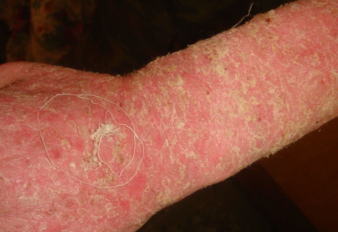 Аллергические реакции