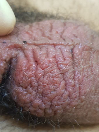 аллергический дерматит с коркой на головке-плоти и мокнутием мошонки4