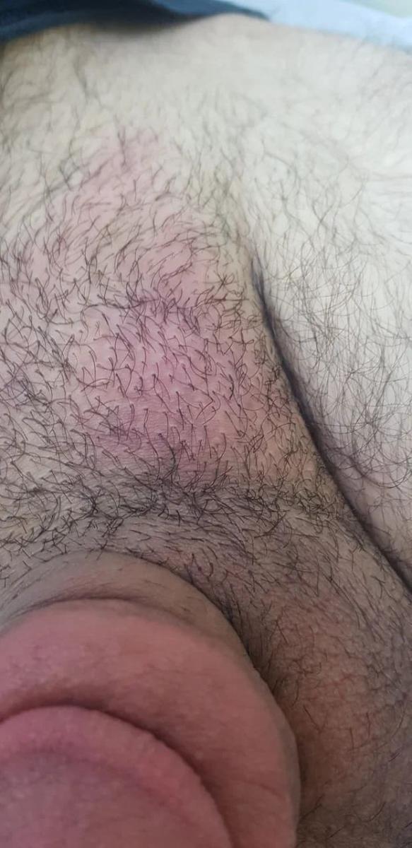 Проявления ИППП отек