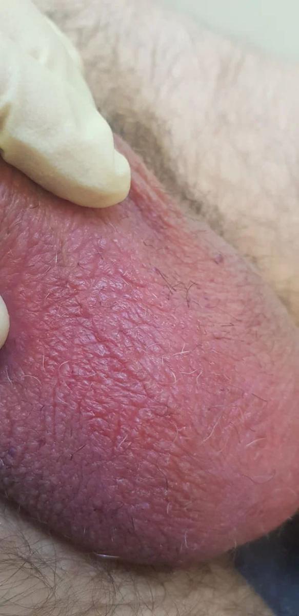 высыпания в виде пятен на половом члене при молочнице