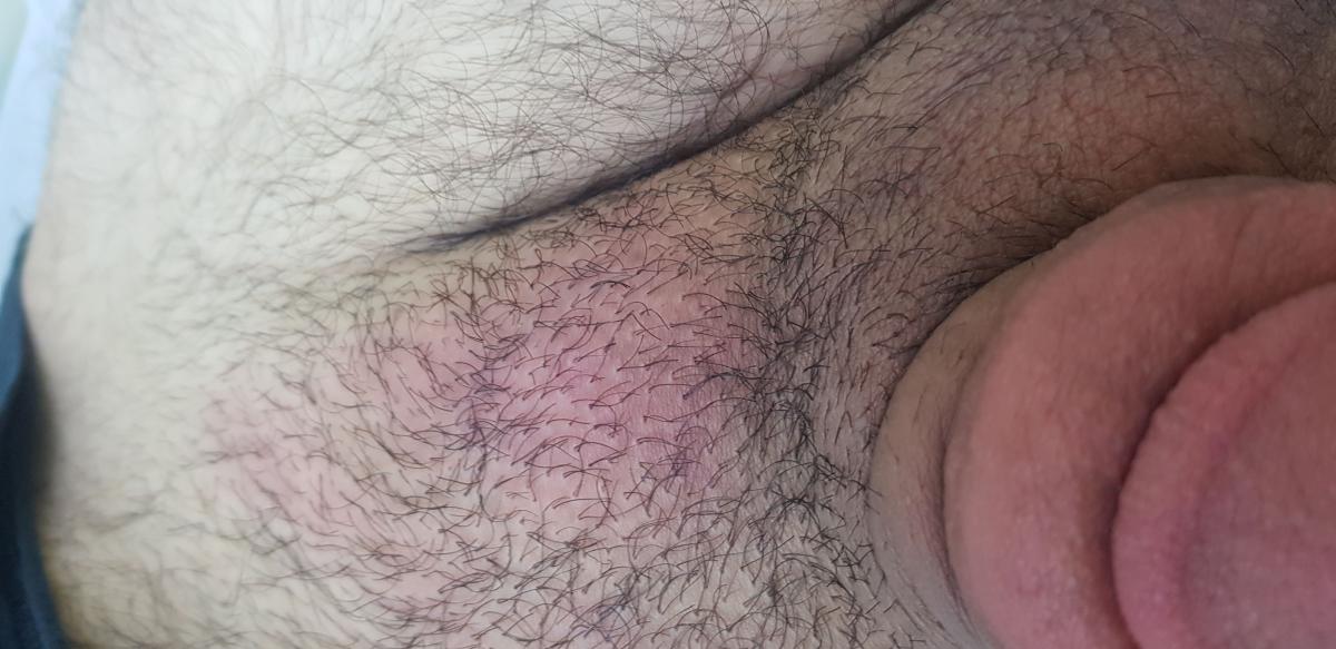 Перерождение тканей лимфатического узла