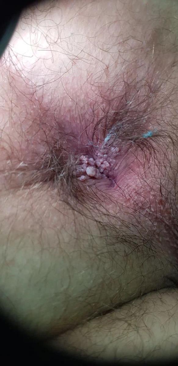 анальные кондиломы анальные кондиломы