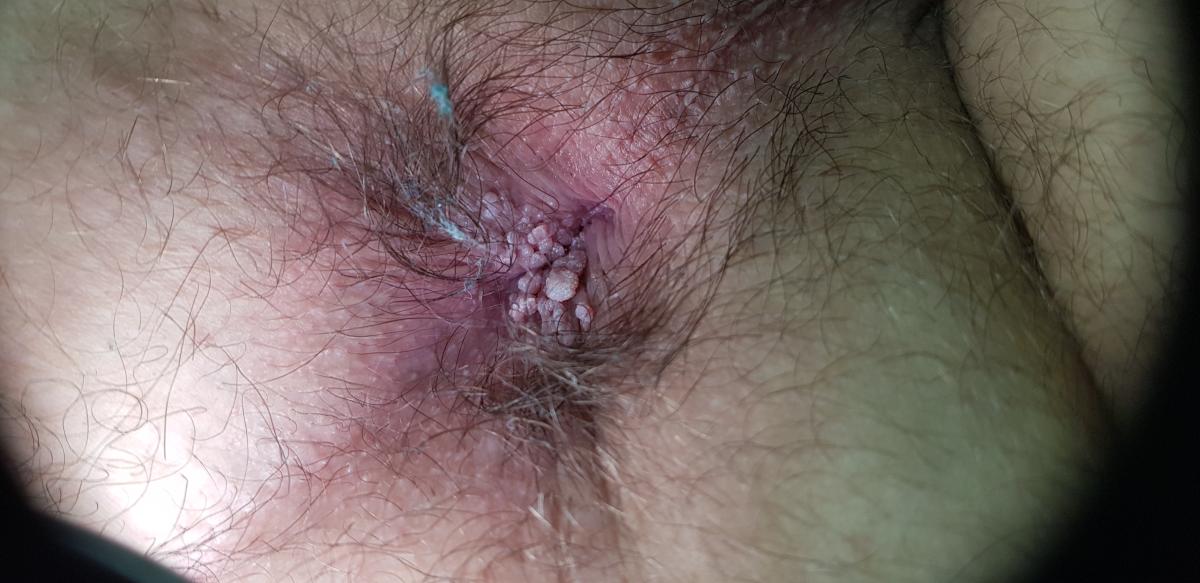 Анальные кондиломы Кондиломы в области ануса