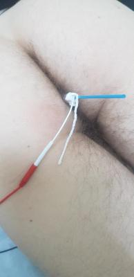 электрофорез в анус электрофорез