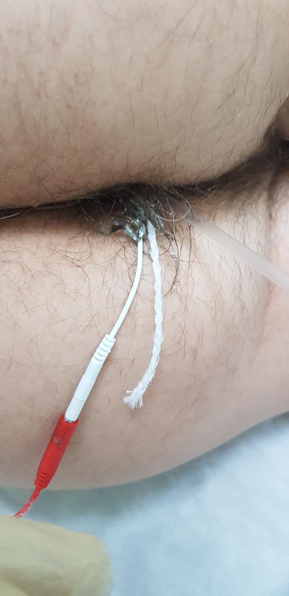 Электрофорез