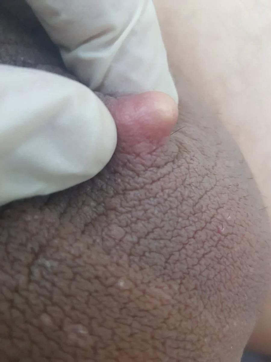 лечение атеромы мошонки лечение атеромы мошонки