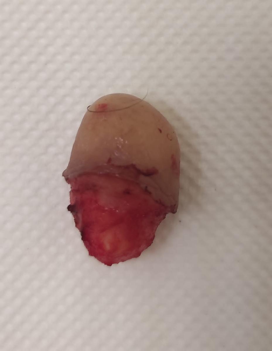 удаленная атерома атерома