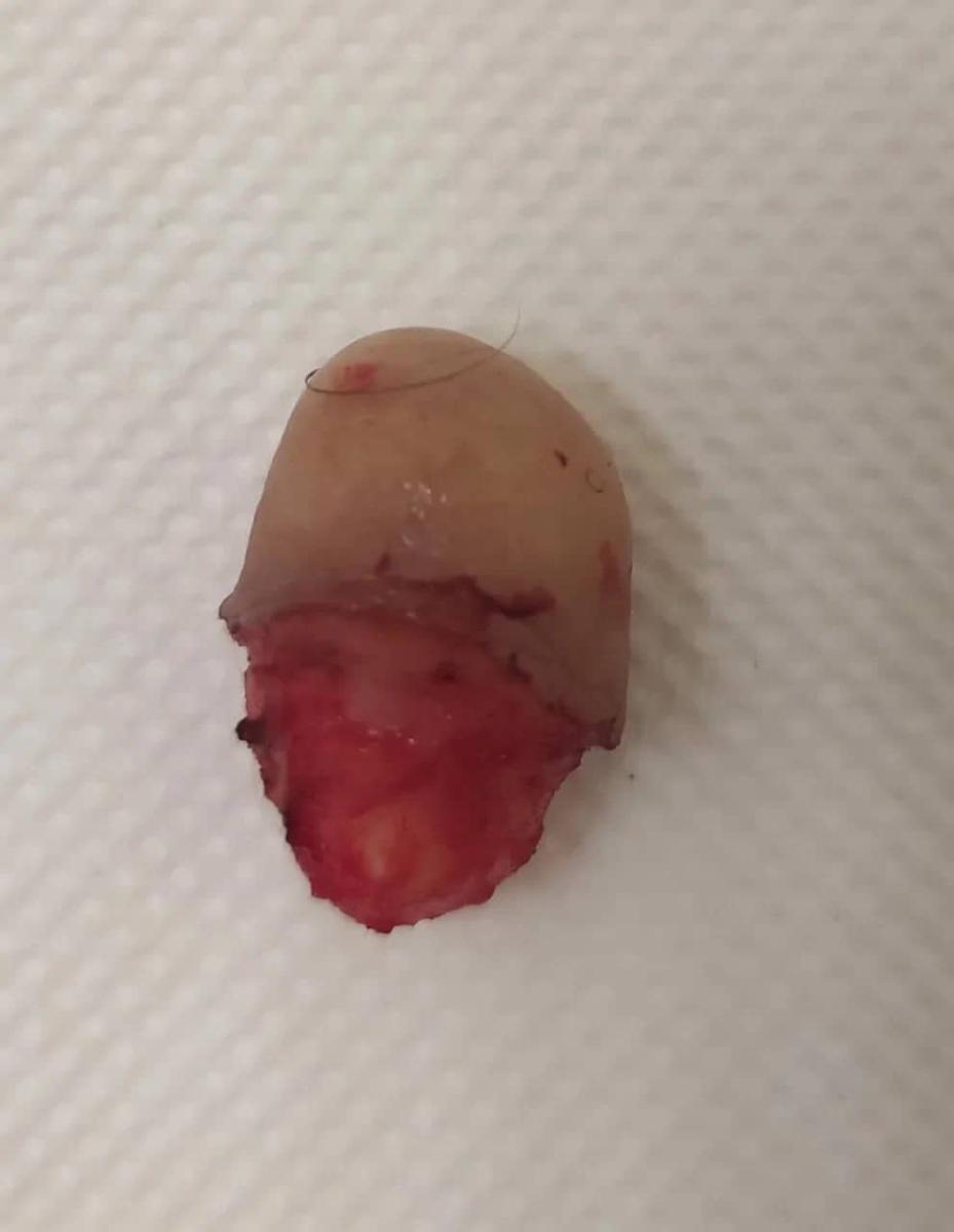 лечение атеромы мошонки лечение атеромы мошонки