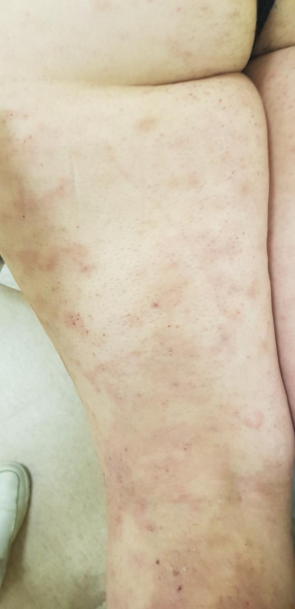 Зуд и шелушение